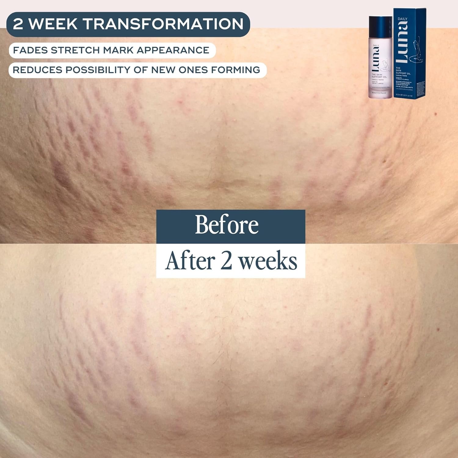 THE SKIN SUPPORT OIL FOR STRETCH MARKS